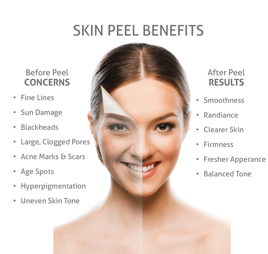 Chemical Peel