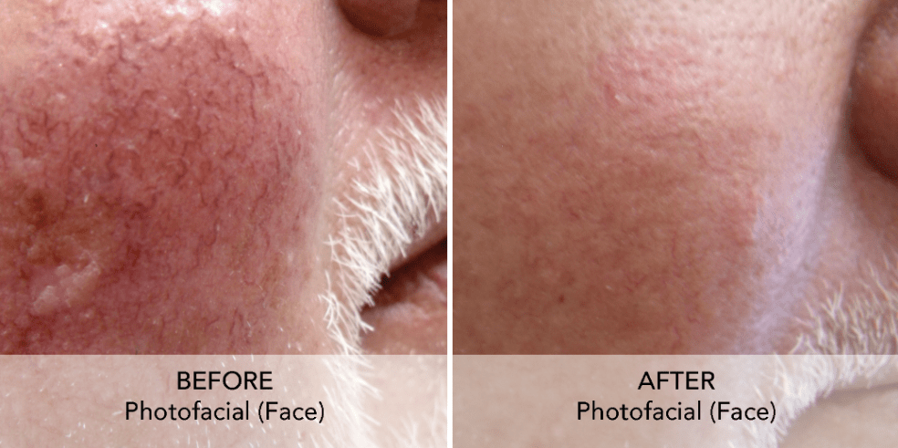 IPL Photofacial blood vessels treatment