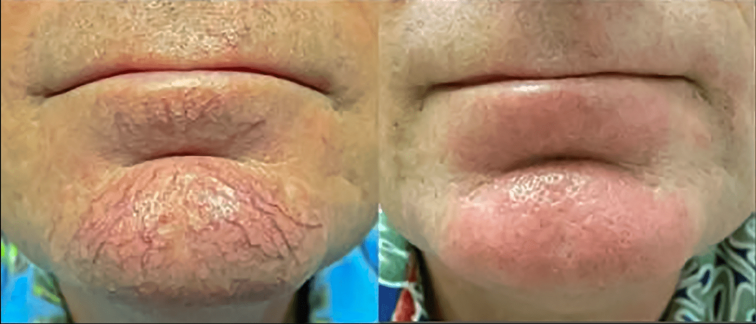 Facial Blood Vessel Treatment