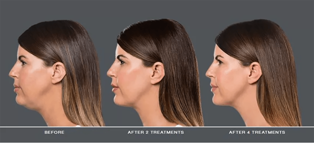 Kybella PCDC treatment at Genesis Spa MD