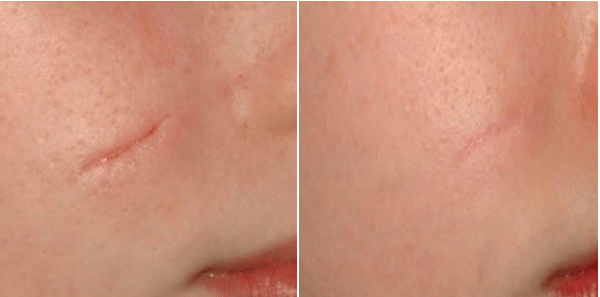 Photofacial Scar Treatment at Genesis Spa MD