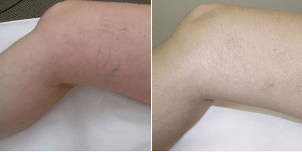Spider Vein Therapy
