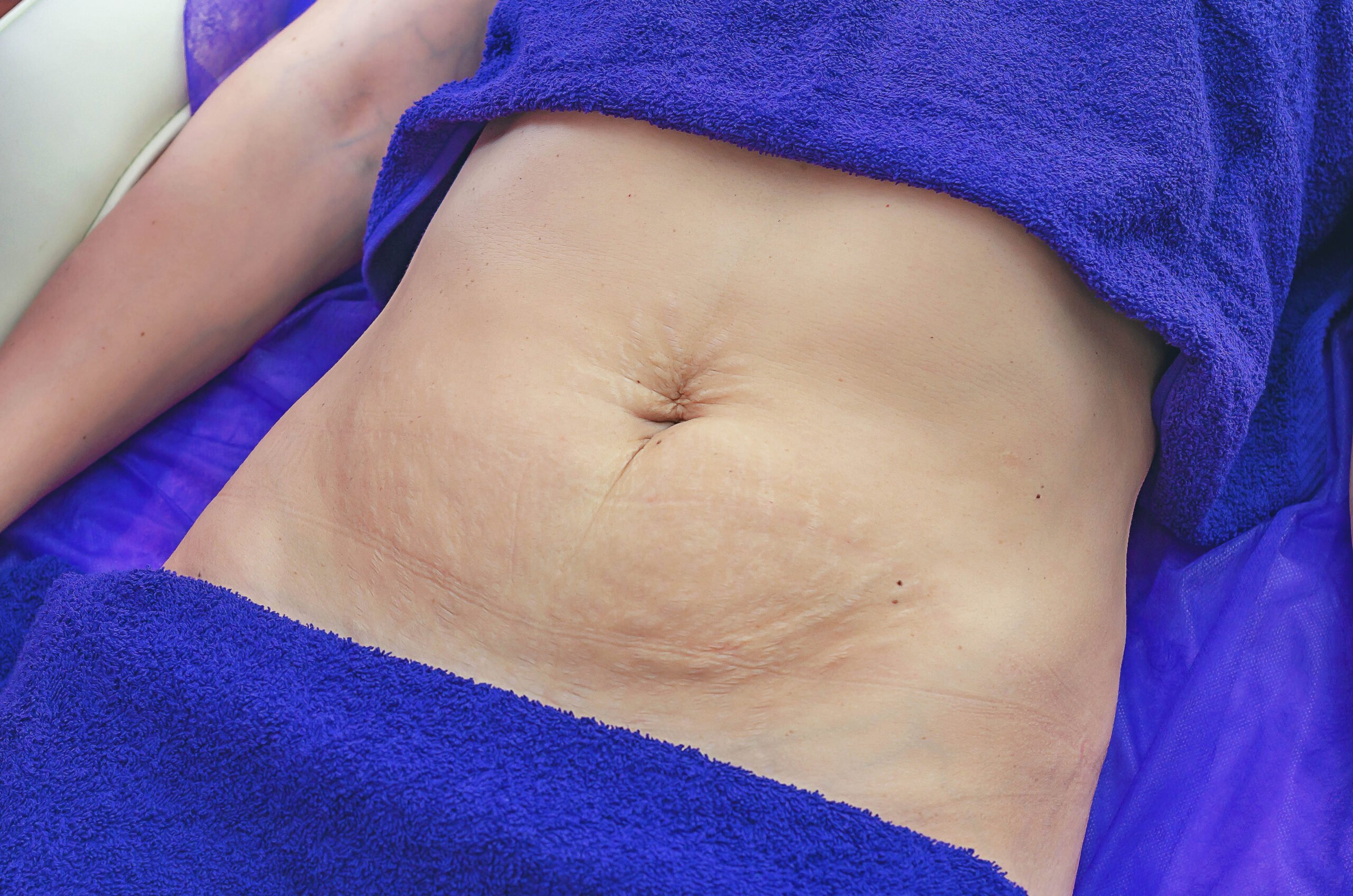 Body sculpting weight loss at Genesis Spa MD