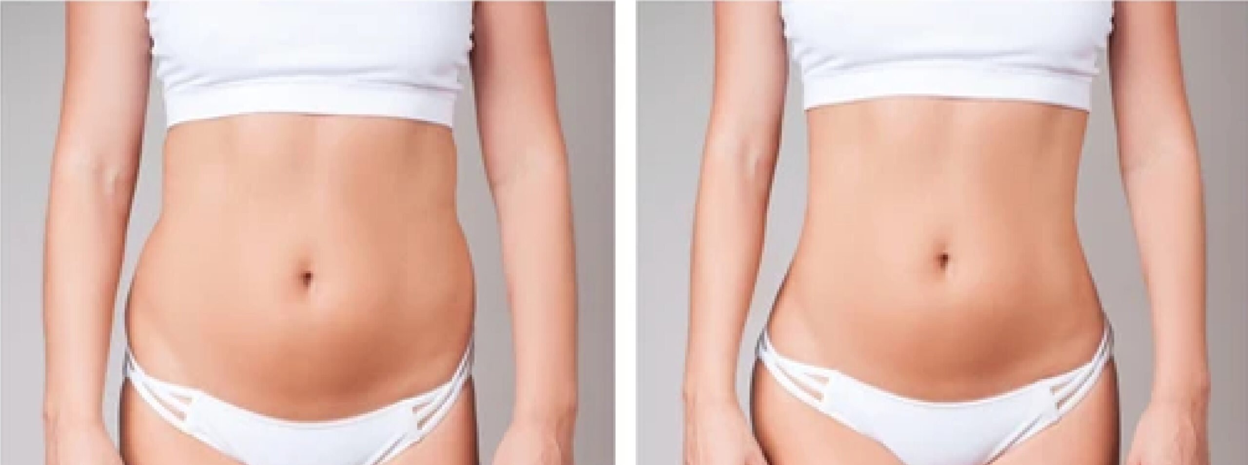 Weight Loss, body sculpting, RF, Microneedling
