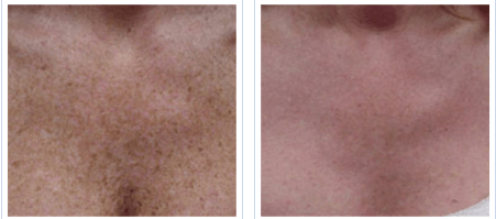 Photofacial, fractional laser, IPL, Decollete treatment