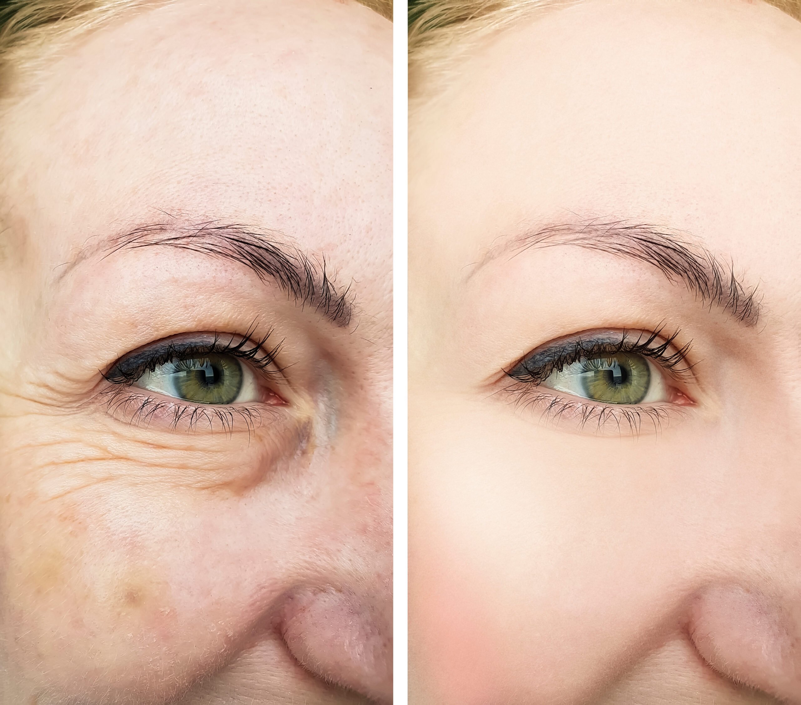 fractional laser treatments at Genesis Spa MD